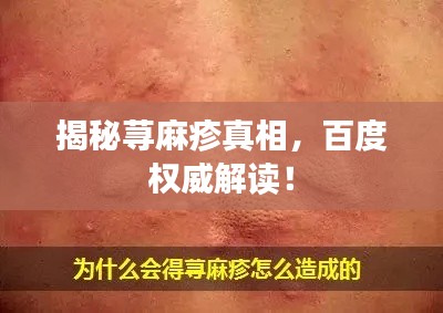 揭秘荨麻疹真相,百度权威解读!