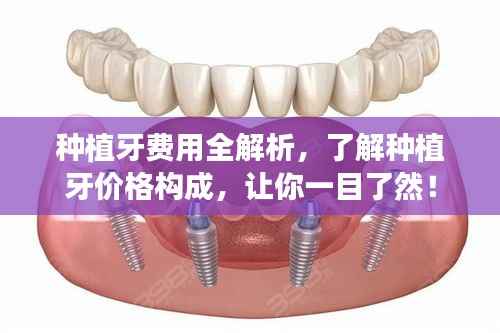 种植牙费用全解析,了解种植牙价格构成,让你一目了然!